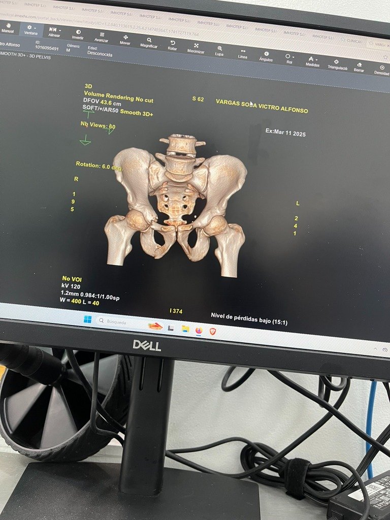 Renderizado 3D de columna y pelvis para diagnóstico de dolor de espalda